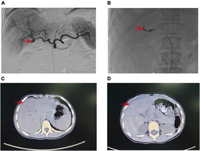 Hepatic artery pseudoaneurysm: three case reports and literature review